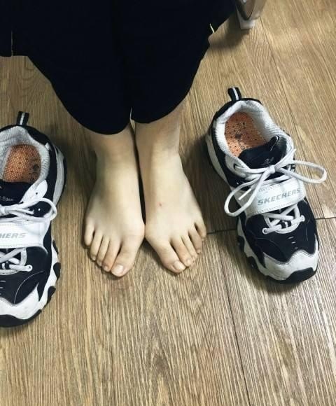 如何快速矫正拇外翻,拇指外翻怎么办