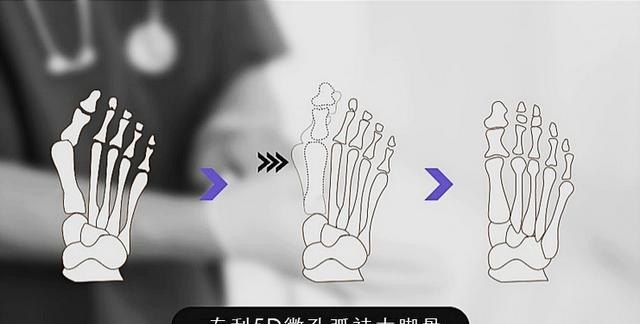 如何快速矫正拇外翻,拇指外翻怎么办