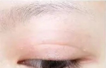 三眼皮双眼皮如何恢复,三眼皮怎么办