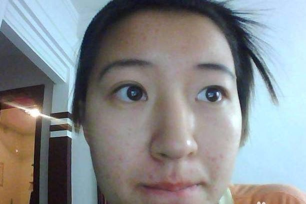 痘痘怎样去除_脸上长痘痘该怎么办