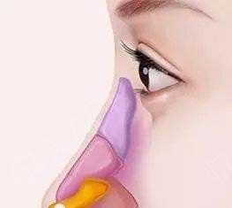 鼻子塌陷怎么办