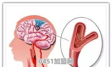 脑溢血的七个前兆信号 早知道或许可保命 具体指什么