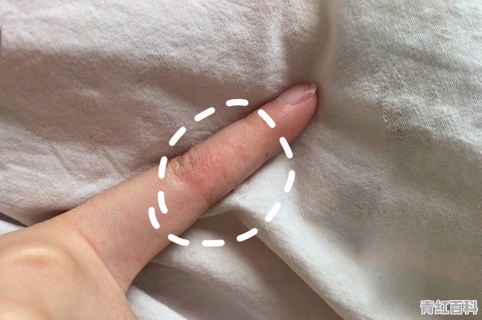 手上反反复复起小水泡，应该怎么治疗