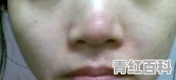 春天脸过敏，又红又痒怎么办