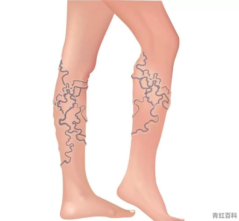 我大腿上有一条条青筋 是什么啊