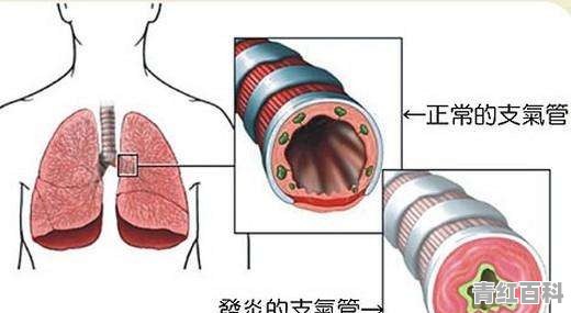 婴儿得了支气管炎有什么缓解方法吗