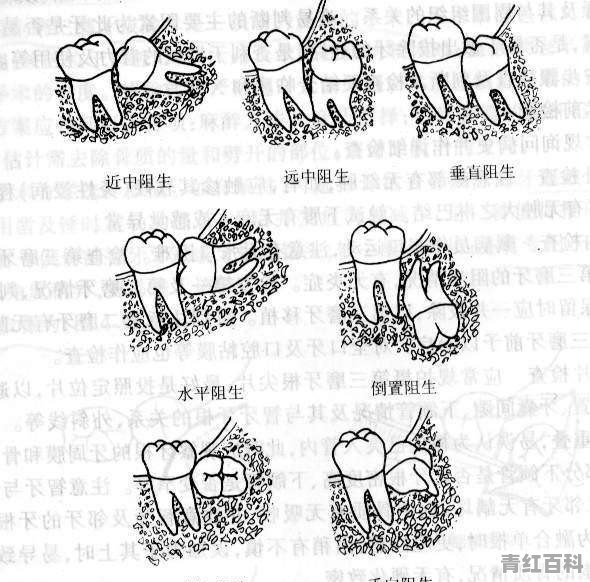 长智齿如何快速止痛