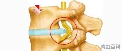 腰间盘突出加椎管狭窄 左侧腿脚麻木 怎么办