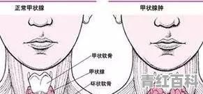 甲状腺发炎怎么办
