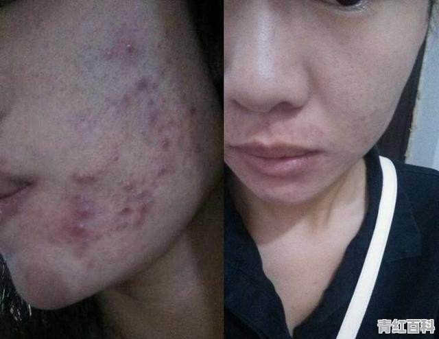 什么是痤疮