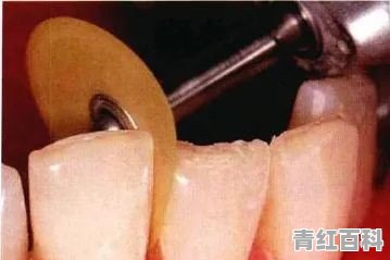 磨牙痛怎么办怎么快速止痛