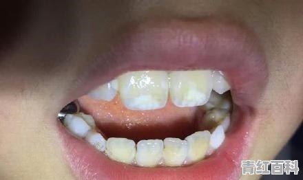 两岁半宝宝牙釉质坏了怎么办