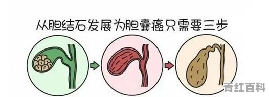 胆结石每天早上腰酸背痛怎么办