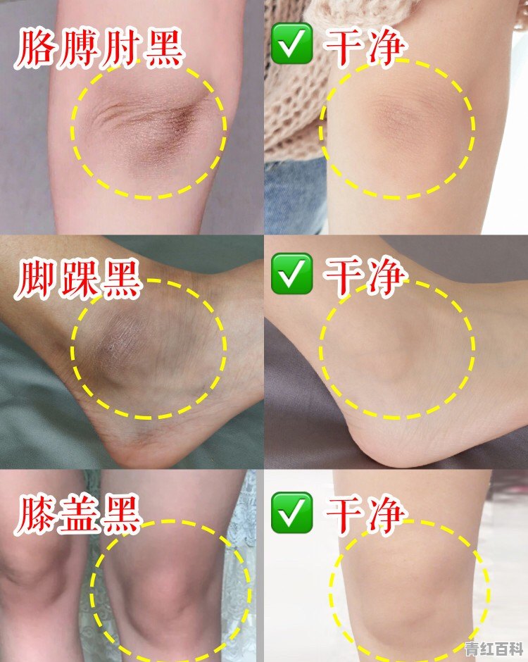 手指关节怎样变白