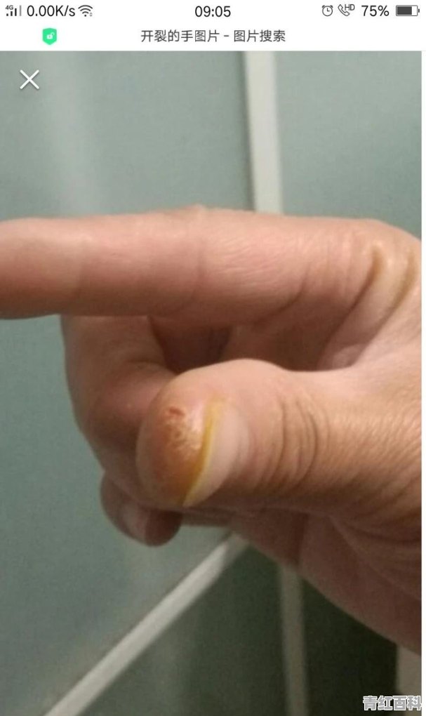 手裂口了怎么办最快最有效