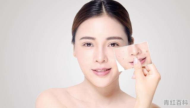 脸上全是痘痘怎么办用什么药