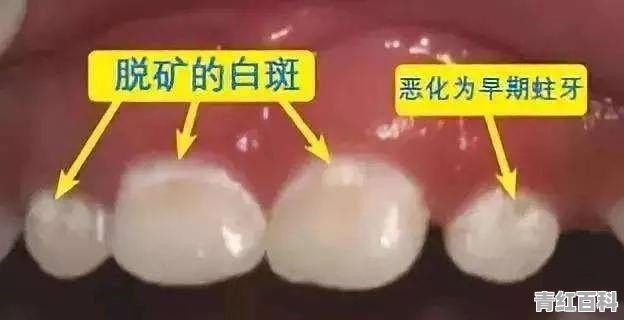 牙齿有白斑用什么牙膏