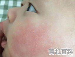 脸上老是发热发红是怎么回事