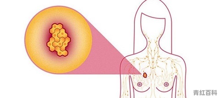 乳房长个结块怎么办
