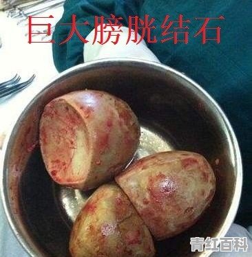 膀胱有结石怎么办,手术要多少钱