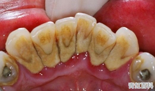 抽烟牙齿黄怎么办变白
