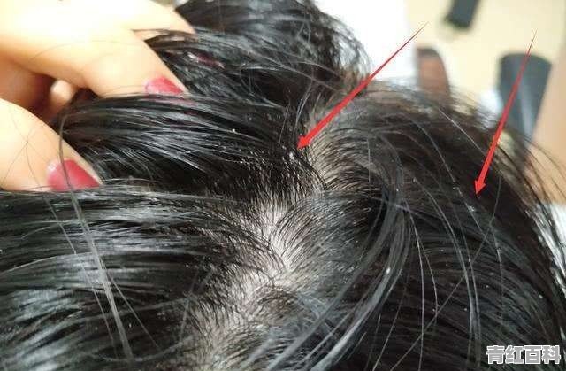 婴儿头部抓破皮了能抹橄榄油吗
