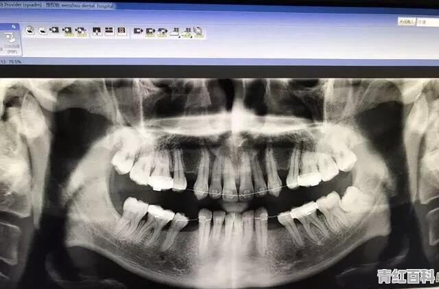 怀孕智齿发炎怎么办快速止痛