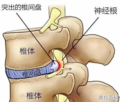 腰椎间盘突出大家都怎么治疗的，有没有什么好办法分享