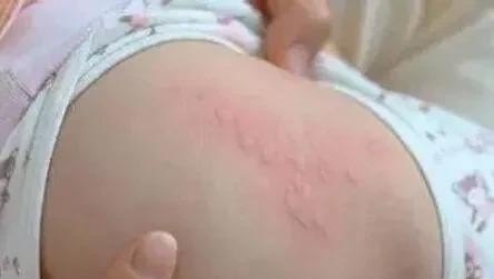 小儿荨麻疹应该怎么治疗