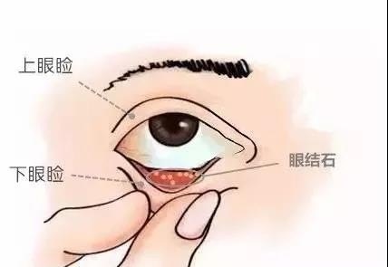 12岁女孩有了眼结石，该怎么办