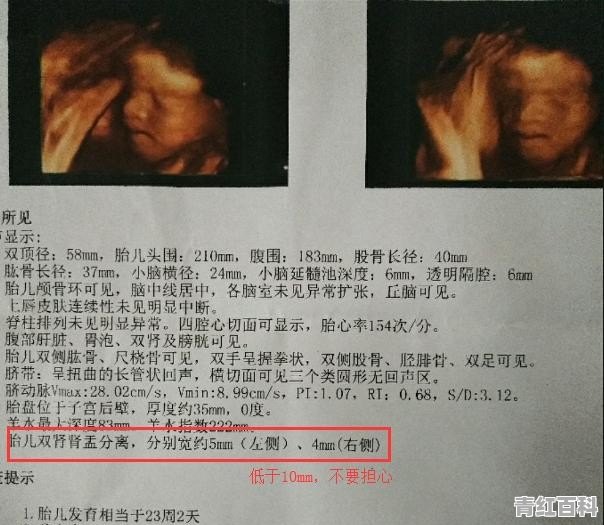 做四维，胎儿双肾肾盂分离，是怎么回事？严重吗