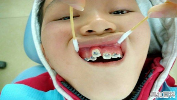 牙齿长歪了怎么办啊