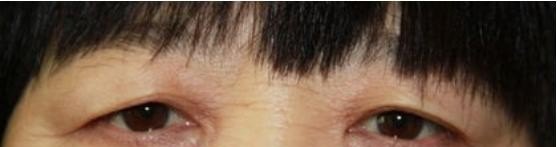 眼皮肿下垂怎么办偏方