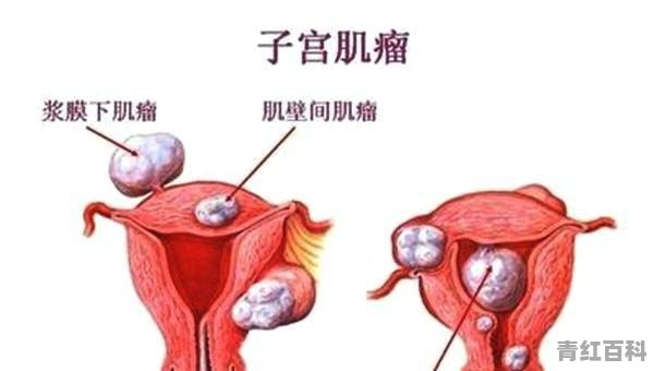 妊娠合并子宫肌瘤怎么治疗