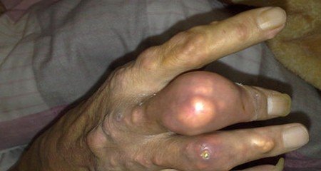 痛风很严重了有痛风石怎么办