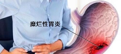 宫颈中度糜烂怎么办严重吗