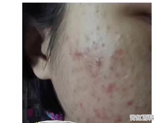 脸上起痘痘怎么办