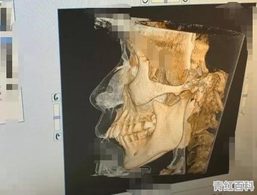 牙套刮嘴怎么办用什么缓解