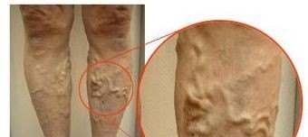 大腿外侧有红血丝是何原因