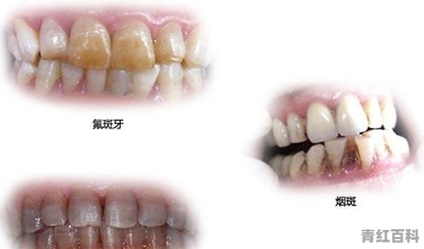 儿童牙齿黑了怎么办