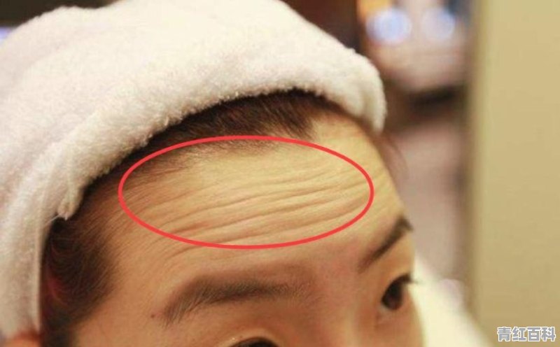 如何去除额头的皱纹