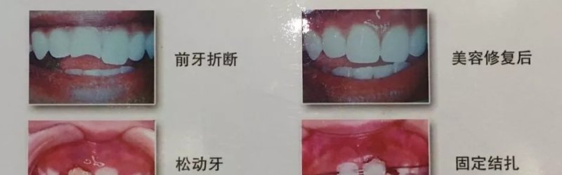牙齿根部有一点小缺损，又不想去医院补牙换牙，有什么自然修复的好方法吗