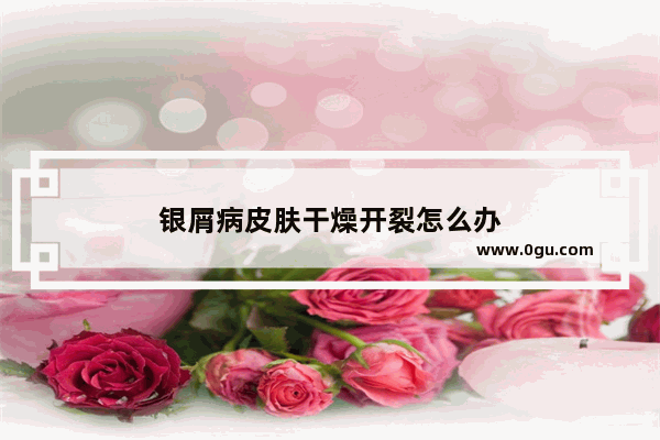 银屑病皮肤干燥开裂怎么办
